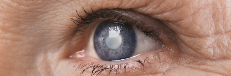 Cataracts img2 - 3 - Dr Juanita Pappalardo